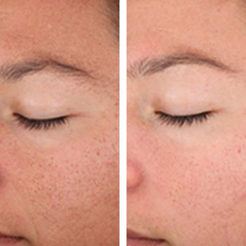 Chemical Peel Before & After - orlando med spa