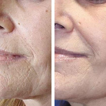Microneedling Before & After - orlando body contouring